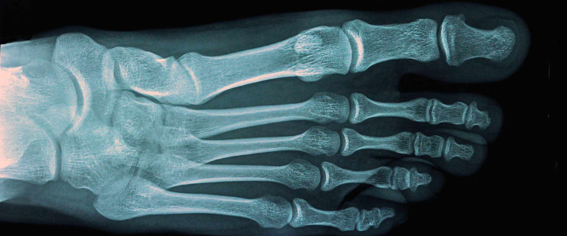 Ventajas cirugía del pie Clinik Podologia Terrassa
