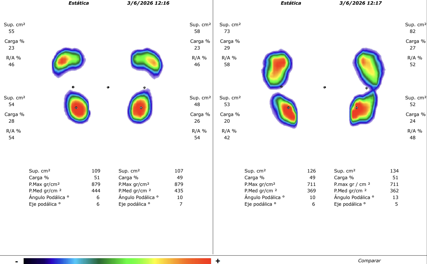 Estudio baropodométrico pies descalzos vs plantillas anteriores Clinik Podologia Terrassa
