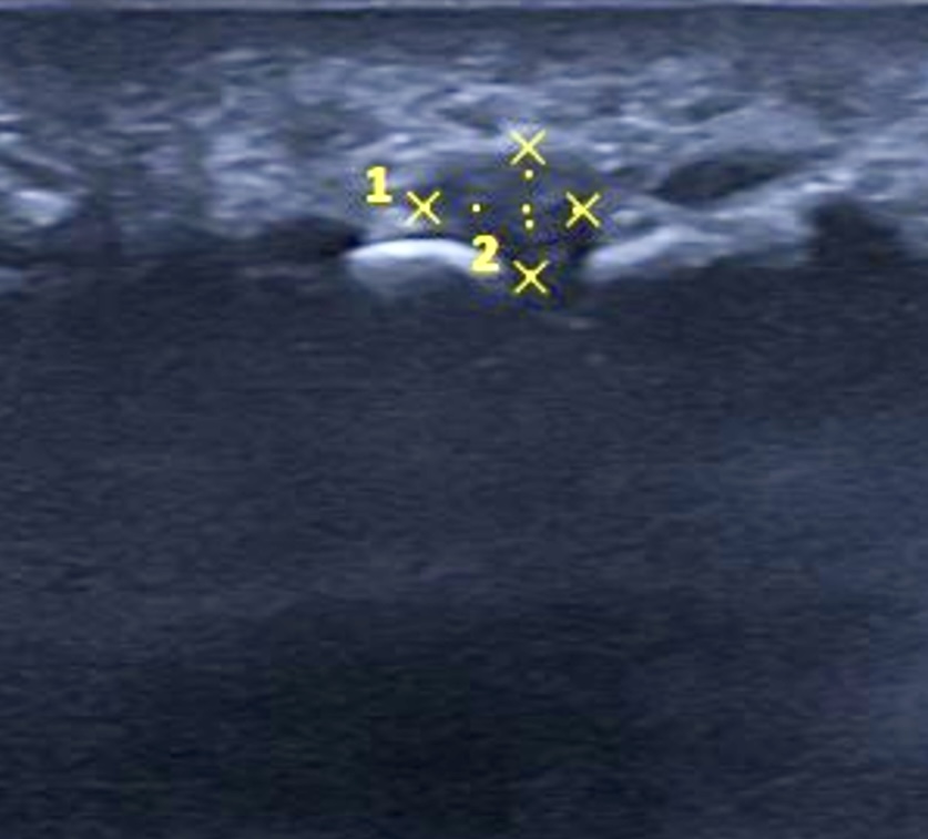 Ecografía hallazgos compatibles con Neuroma de Morton Clinik Podologia Terrassa
